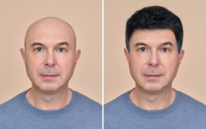 comparison picture of a man with hair restoration