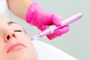 How Long does Microneedling Last?